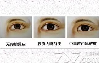 什么人不适合做开眼角手术 这7种人千万别开眼角 