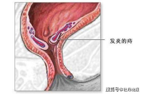 菏泽中医院专家解读 痔疮的科学诊疗与预防