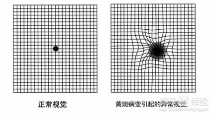 黄斑变性和黄斑裂孔如何治疗