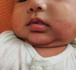 宝宝湿疹,嘴角先知,宝宝嘴角若有这3个特征,快去检测下皮肤