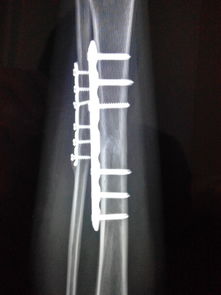 右小腿粉碎性骨折,两年了请医生帮我看看能不能取钢板 