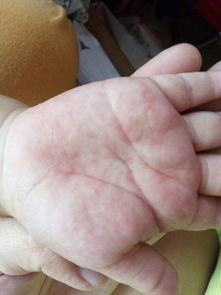 三岁小孩,手心很痒,起了很多小疙瘩,不痒不抓的时候看不出来,开始虎口位置有,现在手心手指缝也有 