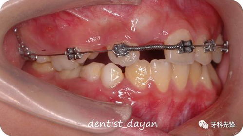 上前牙区多生牙拔除后 埋伏牙正畸牵引 