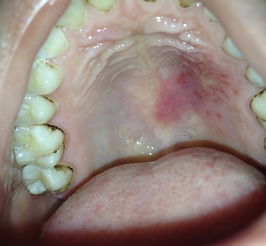 口腔内上颚有小泡图片- 搜狗图片搜索