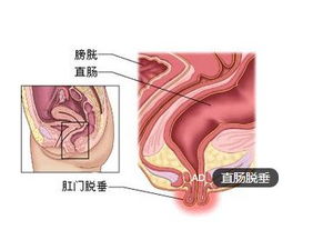 脱肛出现有哪些诱发因素