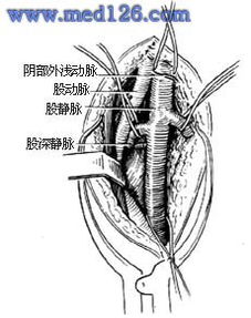 静脉血栓 髂 股静脉血栓摘除术操作步骤,图片图谱图解,血管手术治疗方法 