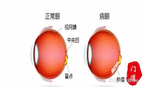 眼部疾病 视网膜母细胞瘤 