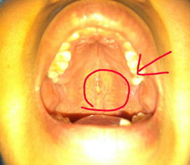 口腔上颚中间位置,凸起一个谈黄色的包,黄豆大小,哪位医生或大神解 