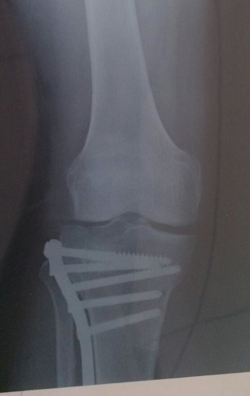 左膝盖平台骨折塌陷术后几周可以下地行走,这个会影响以后行走吗 患者男性53岁 