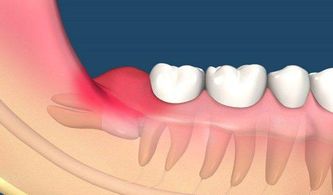 智齿到底需不需要拔除呢 