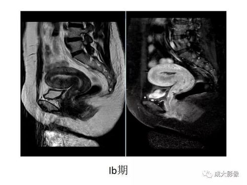 女性盆腔MR扫描规范及子宫内膜癌分期