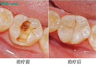 牙齿缺失补牙后有哪些注意事项(牙齿缺失最佳补牙方式)