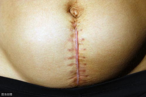 剖腹产后的疤痕，剖腹产的伤疤可以去掉吗 剖腹产的刀疤一般多久会彻底恢复