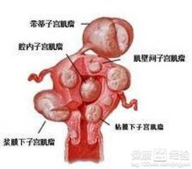 子宫肌瘤饮食疗法