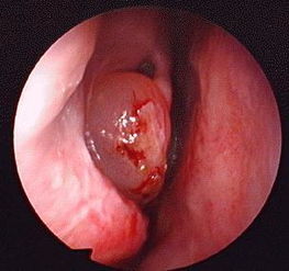 鼻息肉这块肉孩子既然也会患有,这是怎么回事 