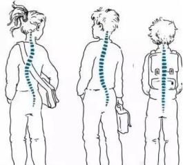 男女发病比例1 7 孩子驼背 高低肩 可能是它惹的祸