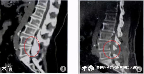 椎管狭窄手术风险(椎管狭窄手术风险有哪些 知乎)