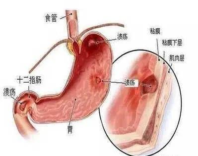 什么是胃食管反流