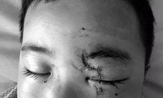 湖南常德一男童幼儿园午睡遭玻璃 袭眼 ,家人称左眼将面临永久性失明