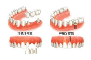 种植牙vs烤瓷牙 比功能,你选择种植牙还是烤瓷牙