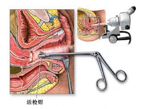 活检对宫颈伤害大吗(活检对宫颈有伤害吗)