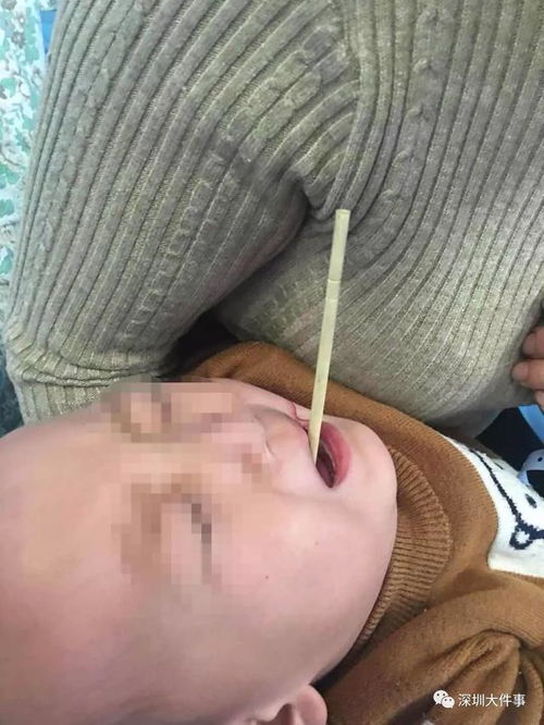 一个小动作,深圳两岁娃被筷子扎入颈部 离戳穿只差1.5cm