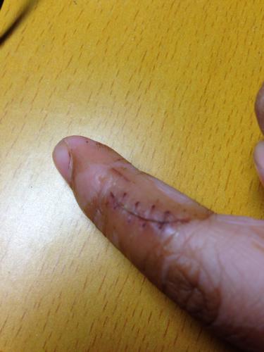 手指拆线后半个月,伤口后半部分老是不愈合伴随周围肉硬硬的,怎么回事,由于这期间手指一直不沾水,手指 