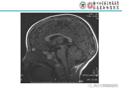 小脑扁桃体下疝畸形 Chiari畸形