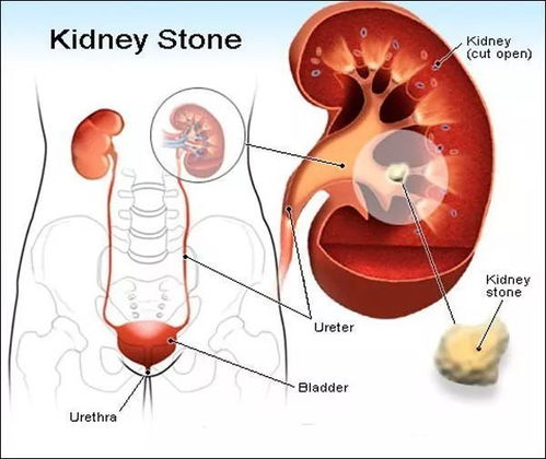 肾结石有什么症状