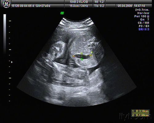 钙化胎儿(胎儿钙化是什么意思,胎儿钙化灶的危害大吗)