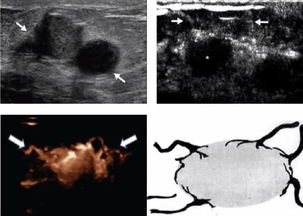 为什么乳腺肿瘤不做钼靶,反而做超声造影