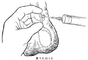 输精管结扎术