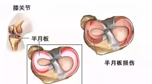 膝盖疼痛就一定是关节炎吗 中老年人膝盖疼痛还可能是半月板损伤