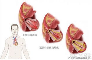 动脉硬化症，动脉硬化有哪些症状