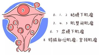 女性易得的妇科疾病NO.1,会影响生宝宝吗