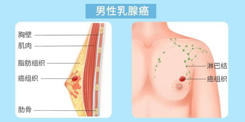 17岁帅小伙长 大胸 ,40岁大叔得乳腺癌 有这4个症状,男性也要警惕乳腺病