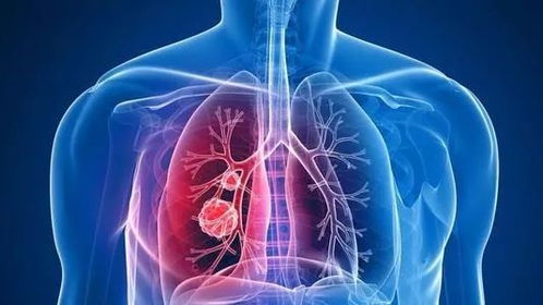 有关肺部小结节的9个常见问题解答