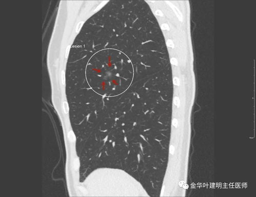 陈旧性肺结核传染吗 与肺结核患者一起生活，会被传染吗？肺结核的早期症状有哪些？ 