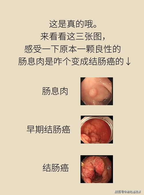 长了肠息肉不用切 先问问大肠癌同不同意 