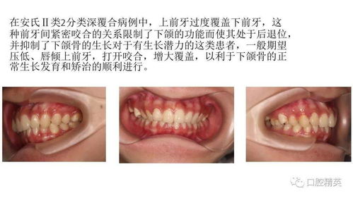 正畸临床打开咬合的方法讲义 