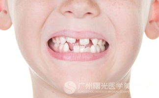 牙齿缺损有什么危害