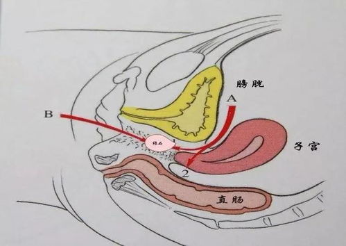 什么是 石女 先天 无阴道 是咋回事 和正常女性有何区别