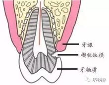 还这样刷牙 小心楔状缺损来找你