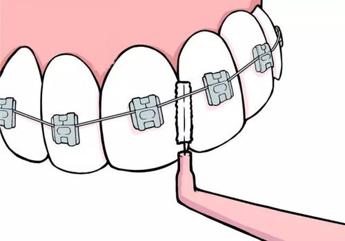 牙齿矫正时那些正确的刷牙方法
