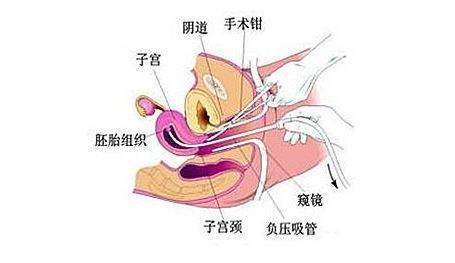 慈溪无痛人流 哪家好 