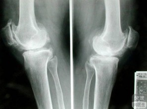 膝关节骨质增生是如何发展而来的