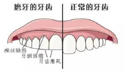 当你睡着以后,夜磨牙悄然开始,多半跟这3种因素有关