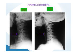 颈椎X光片最强 最全讲解,治疗颈椎必备技能