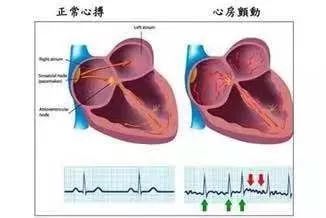 关注心房颤,远离脑卒中 桂林医学院第二附属医院心血管内科成功完成两例房颤患者左心耳封堵 射频消融 一站式 手术